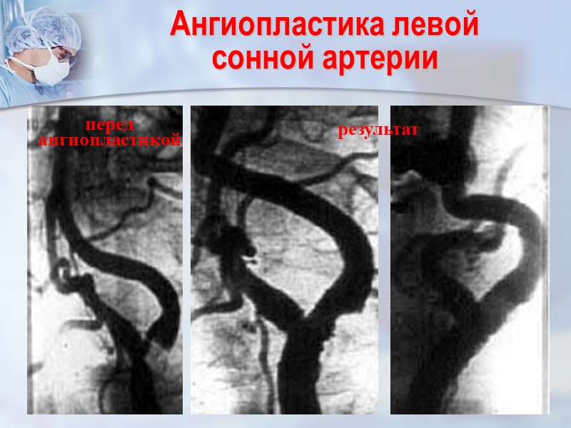 Ангиопластика левой  сонной артерии перед ангиопластикой результат